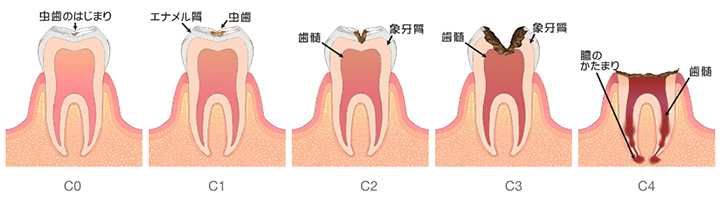 むし歯の進行状況