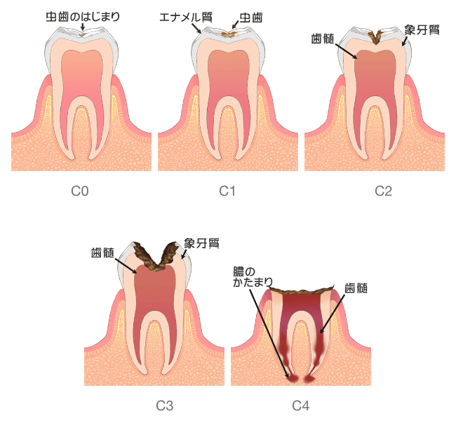 むし歯の進行状況
