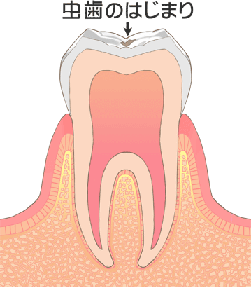 C0 ごく初期のむし歯