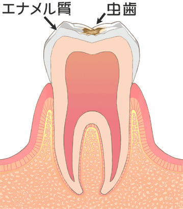 C1　エナメル質の虫歯