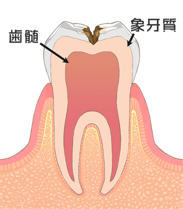 C2　象牙質の虫歯