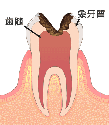 C3　神経まで達した虫歯