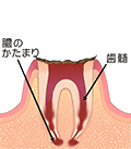 C4 歯根まで達した虫歯