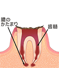 C4　歯根まで達した虫歯